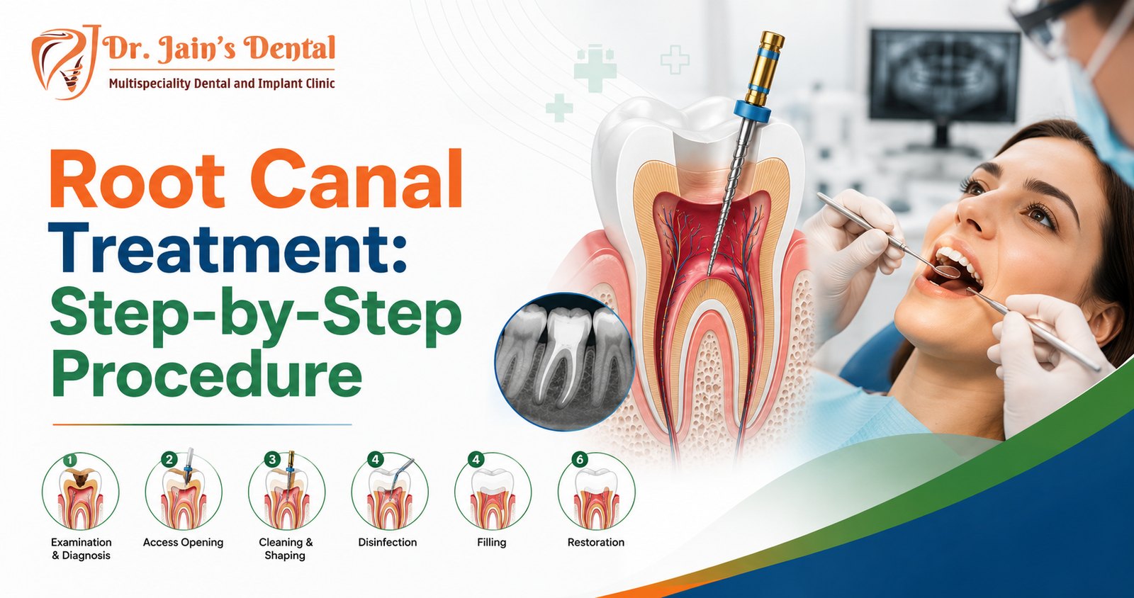 Root Canal Treatment: Step-by-Step Procedure